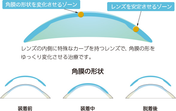 レンズゾーンの図・角膜形状変化の図